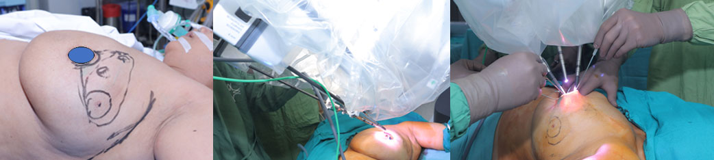 Circumareolar Access through Robot