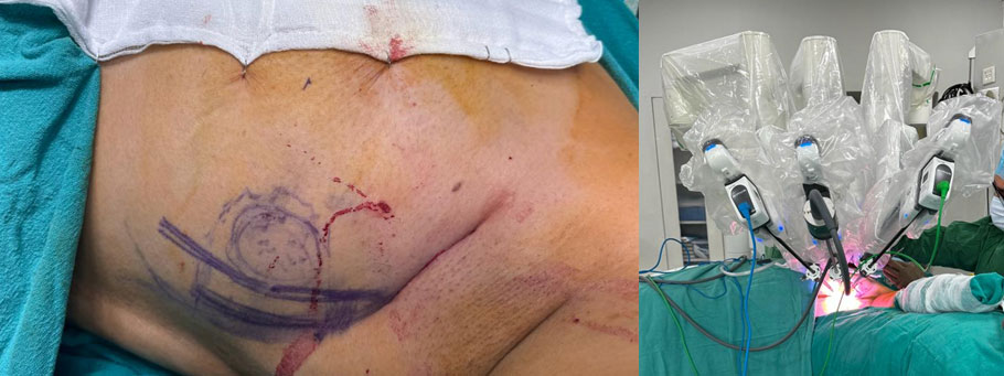 Lateral Mammary Crease Access through Robot