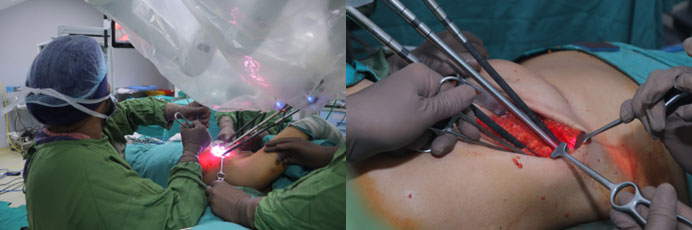 Latissimus tissue dissection through robot