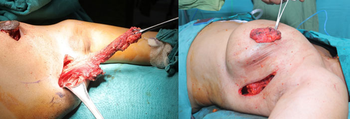 Latissimus tissue mobilized into axilla and breast defect